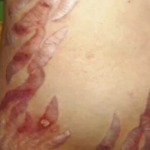 Sindrome cushing